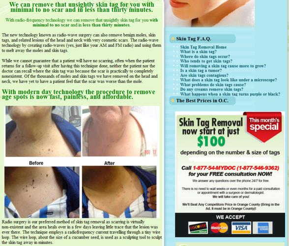 Radiofrequency SKIN TAG REMOVAL - No scar. No Pain! Best Prices in O.C!!!